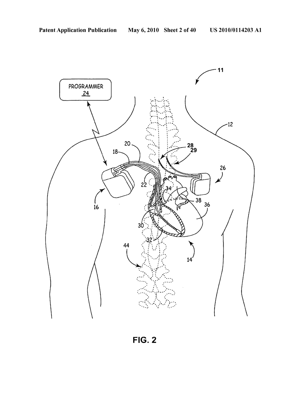 IMPLANTABLE MEDICAL DEVICE CROSSTALK EVALUATION AND MITIGATION - diagram, schematic, and image 03