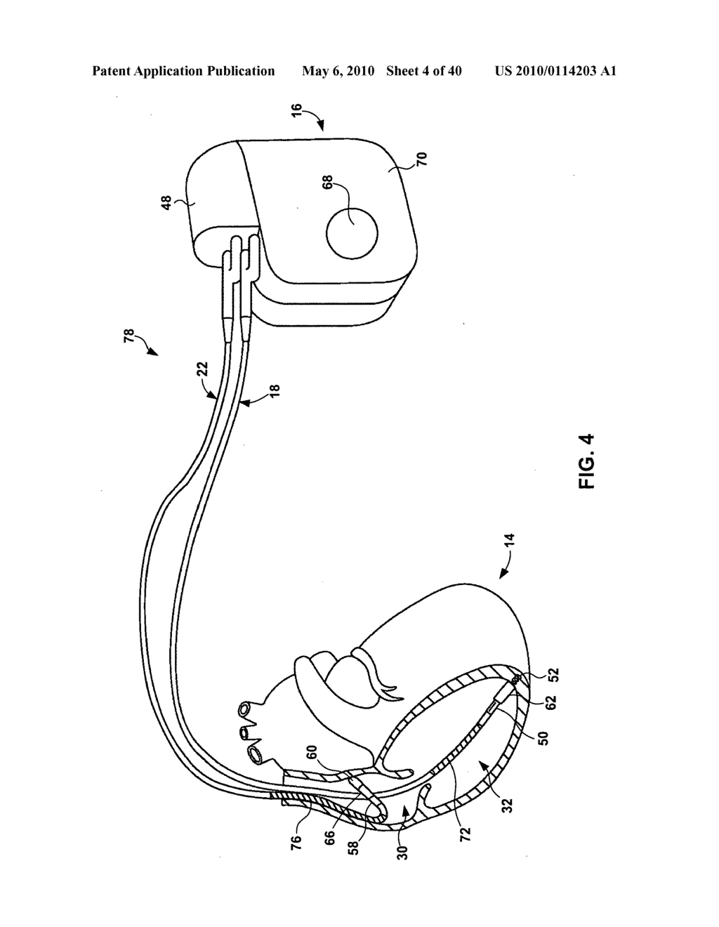 IMPLANTABLE MEDICAL DEVICE CROSSTALK EVALUATION AND MITIGATION - diagram, schematic, and image 05