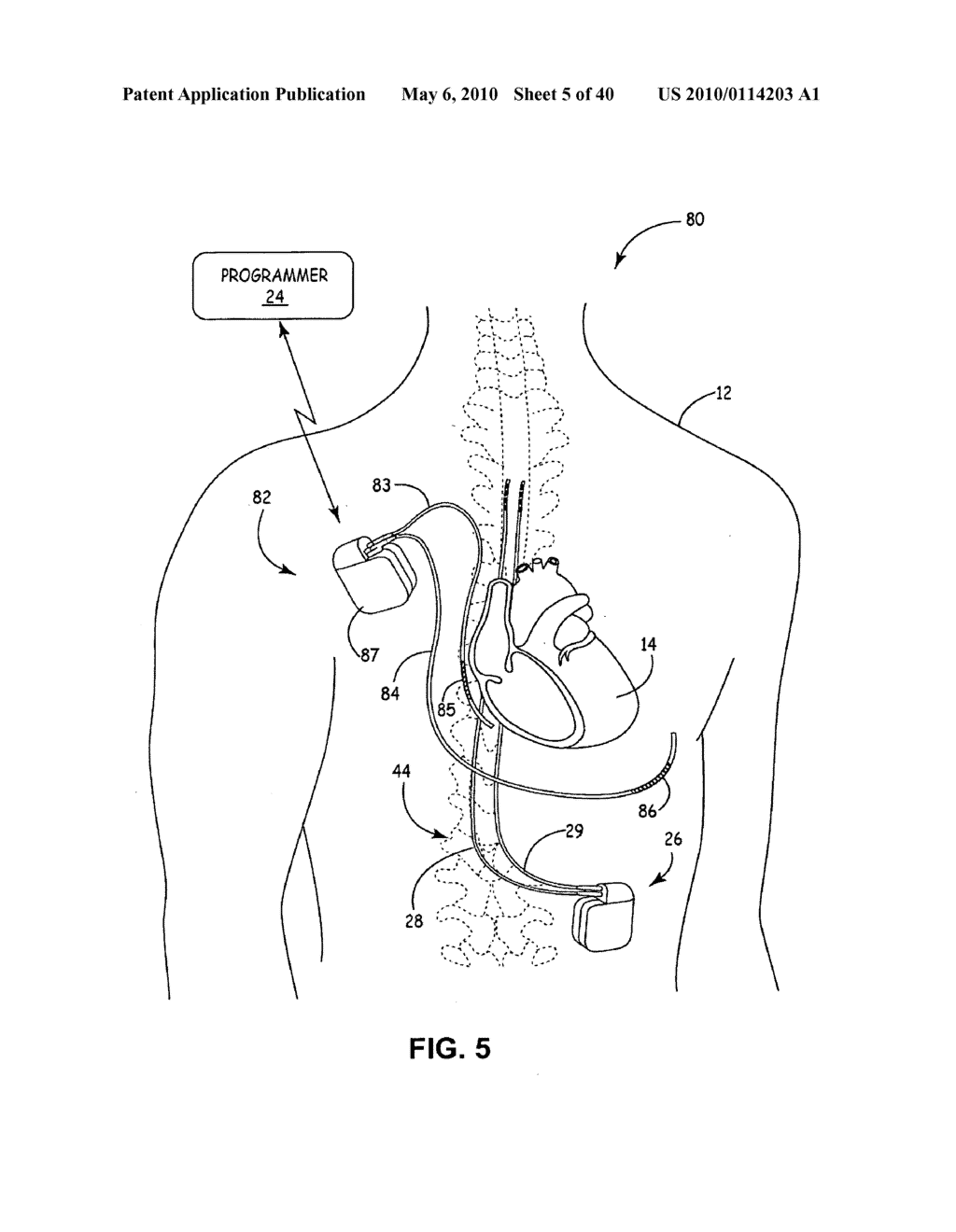 IMPLANTABLE MEDICAL DEVICE CROSSTALK EVALUATION AND MITIGATION - diagram, schematic, and image 06