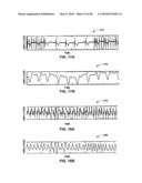 IMPLANTABLE MEDICAL DEVICE CROSSTALK EVALUATION AND MITIGATION diagram and image