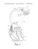 INTERFERENTIAL CARDIAC PRECONDITIONING AND DEPOLARIZATION diagram and image