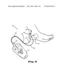 Method and Apparatus for Stimulating a Nerve of a Patient diagram and image