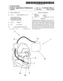 IMPLANTABLE LINE diagram and image