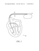 LEAD ASSEMBLY WITH POROUS POLYETHYLENE COVER diagram and image