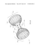 FLOW REDUCING IMPLANT diagram and image