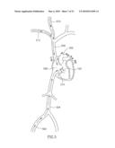 FLOW REDUCING IMPLANT diagram and image