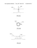 FLOW REDUCING IMPLANT diagram and image