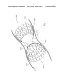 FLOW REDUCING IMPLANT diagram and image