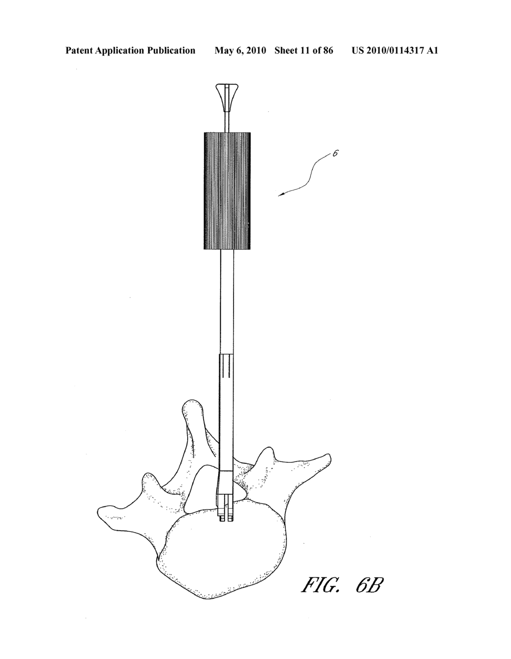 IMPACTION GRAFTING FOR VERTEBRAL FUSION - diagram, schematic, and image 12