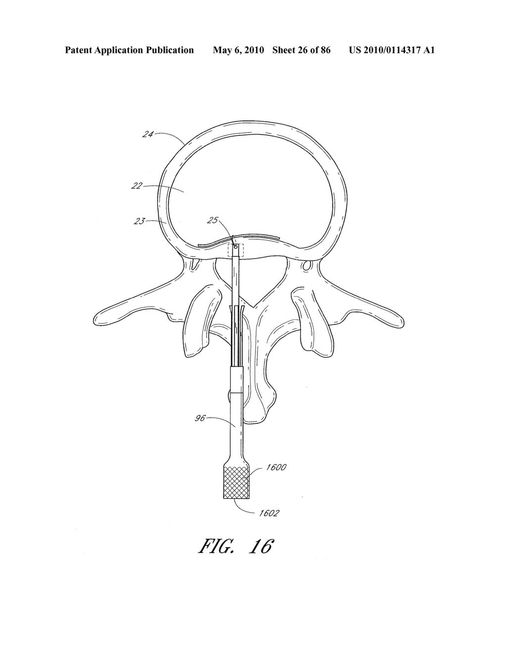 IMPACTION GRAFTING FOR VERTEBRAL FUSION - diagram, schematic, and image 27