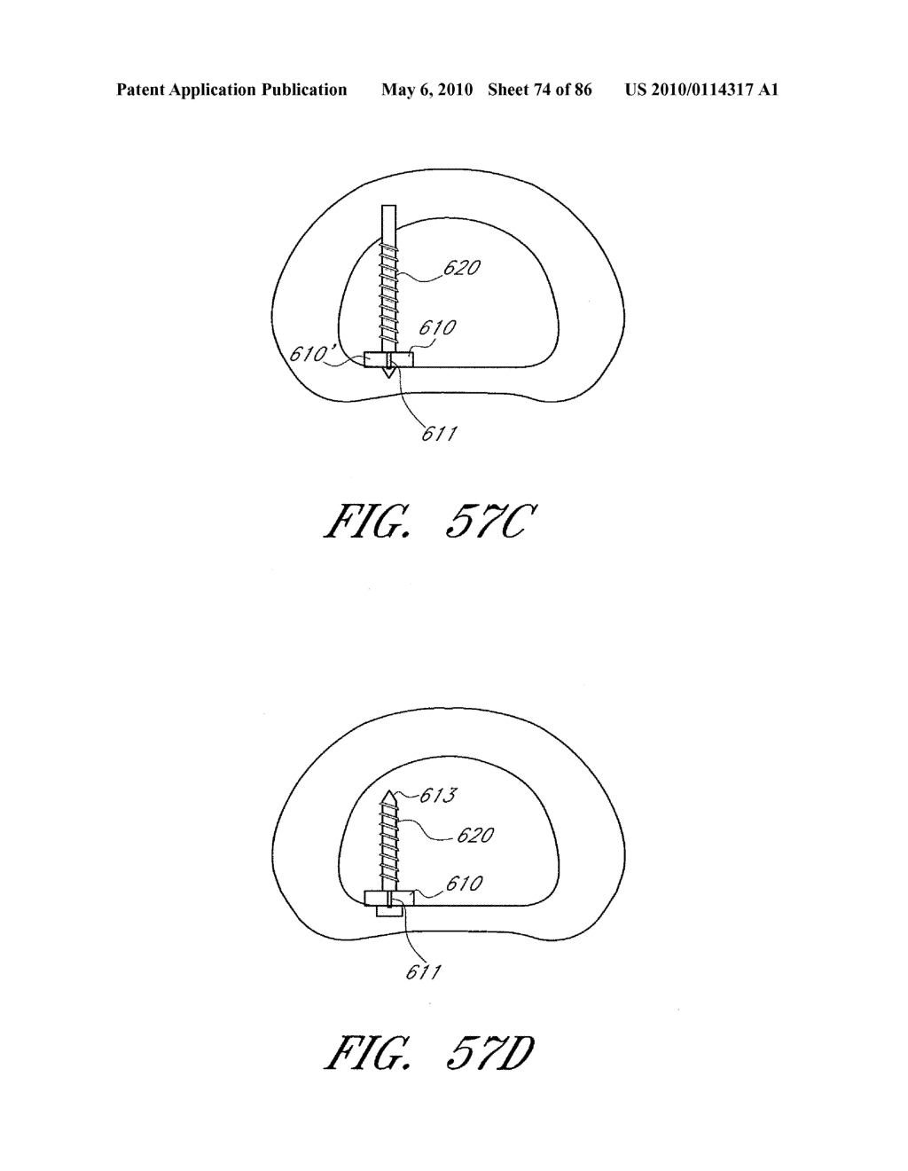 IMPACTION GRAFTING FOR VERTEBRAL FUSION - diagram, schematic, and image 75