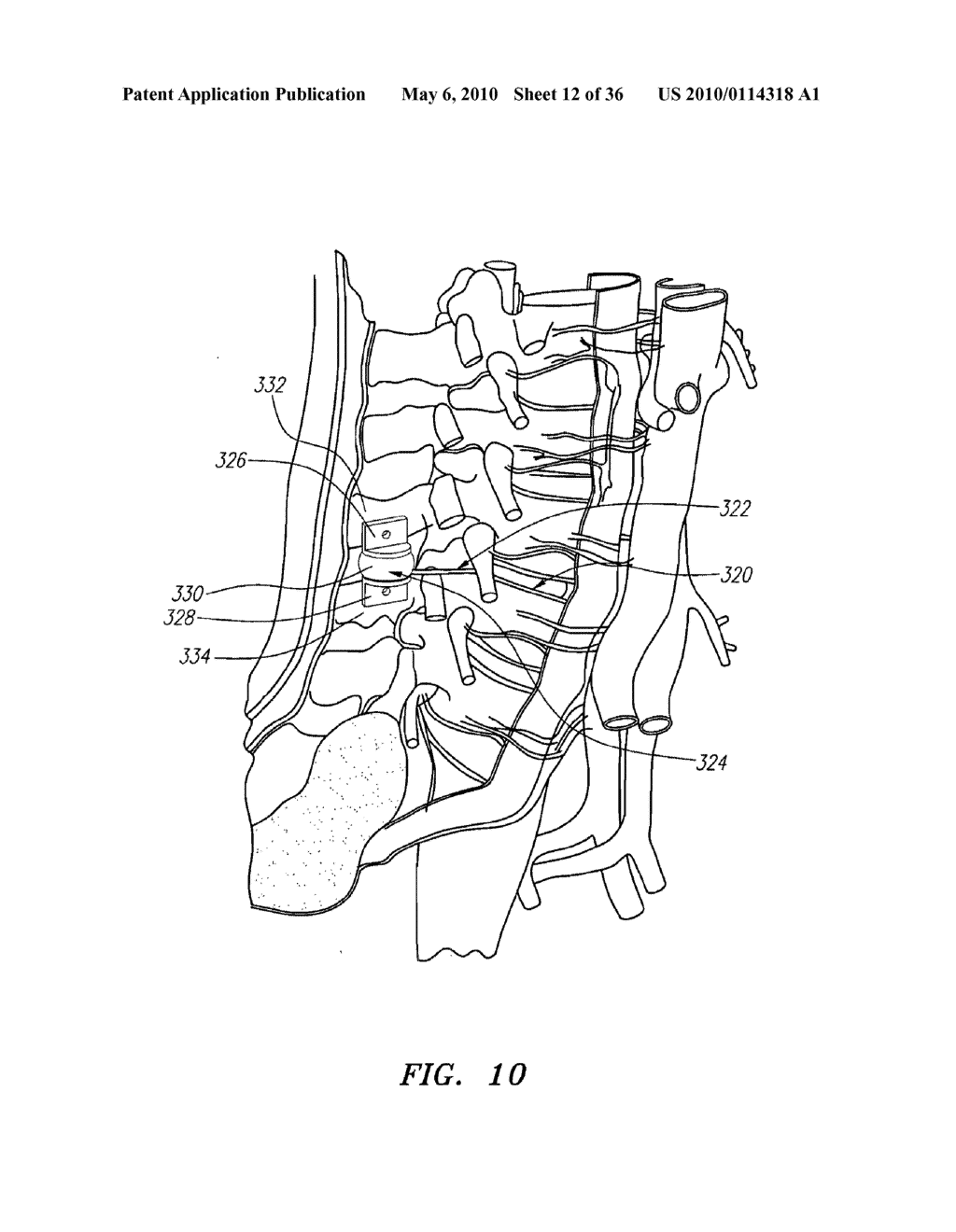 Prosthetic Intervertebral Discs - diagram, schematic, and image 13