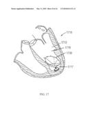CARDIAC DEVICE AND METHODS OF USE THEREOF diagram and image