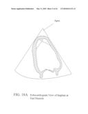 CARDIAC DEVICE AND METHODS OF USE THEREOF diagram and image