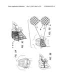 Method and Apparatus of Low Strength Electric Field Network-Mediated Delivery of Drug, Gene, SI-RNA, SH-RNA Protein, Peptide, Antibody or Other Biomedical and Therapeutic Molecules and Reagents in Solid Organs diagram and image