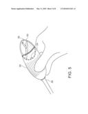 Anti-Adhesion Spraying diagram and image