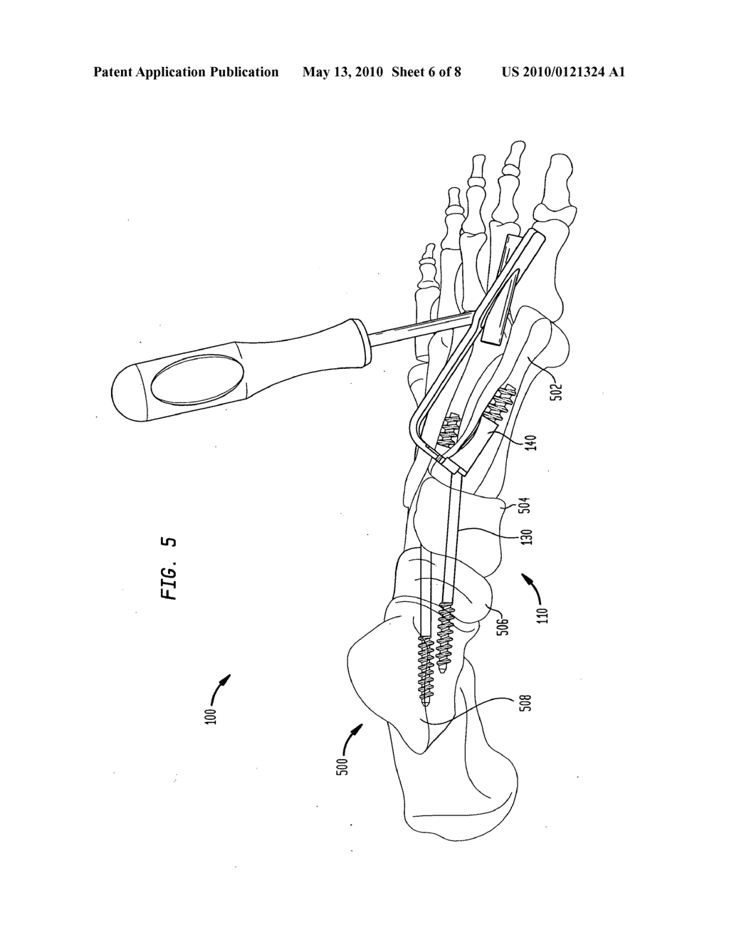 Fixation system, an intramedullary fixation assembly and method of use - diagram, schematic, and image 07