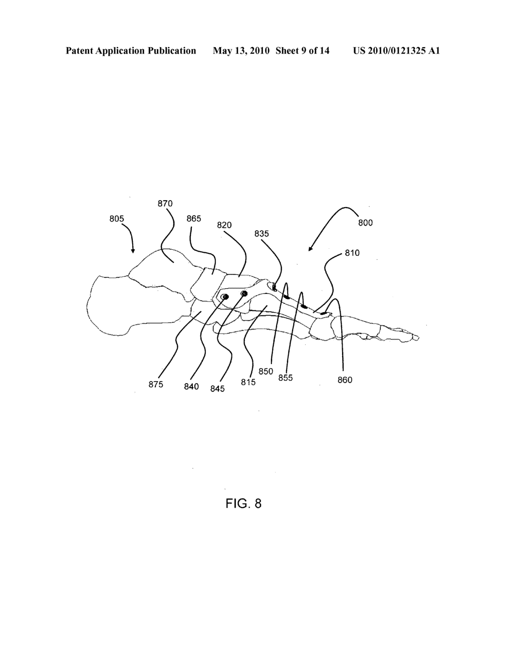 Hybrid intramedullary fixation assembly and method of use - diagram, schematic, and image 10