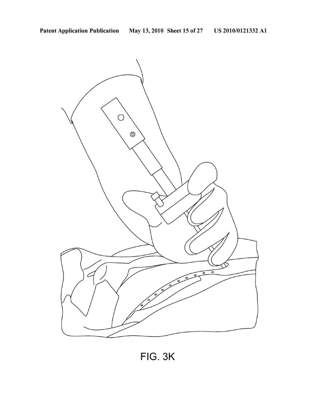 DEVICES AND METHODS FOR VERTEBROSTENTING - diagram, schematic, and image 16