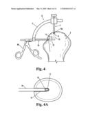 DEVICE FOR DRILLING ANGLED OSTEAL TUNNELS diagram and image