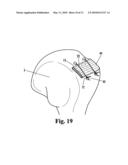 DEVICE FOR DRILLING ANGLED OSTEAL TUNNELS diagram and image