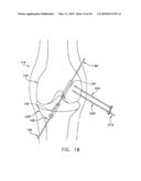 METHOD AND APPARATUS FOR FIXING A GRAFT IN A BONE TUNNEL diagram and image