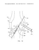 METHOD AND APPARATUS FOR FIXING A GRAFT IN A BONE TUNNEL diagram and image