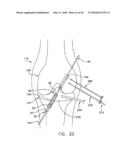 METHOD AND APPARATUS FOR FIXING A GRAFT IN A BONE TUNNEL diagram and image