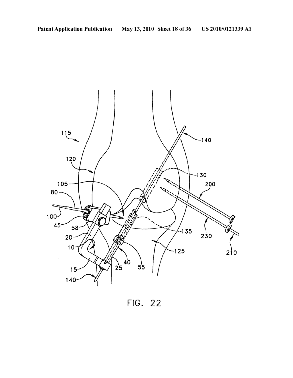 METHOD AND APPARATUS FOR FIXING A GRAFT IN A BONE TUNNEL - diagram, schematic, and image 19