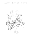 METHOD AND APPARATUS FOR FIXING A GRAFT IN A BONE TUNNEL diagram and image