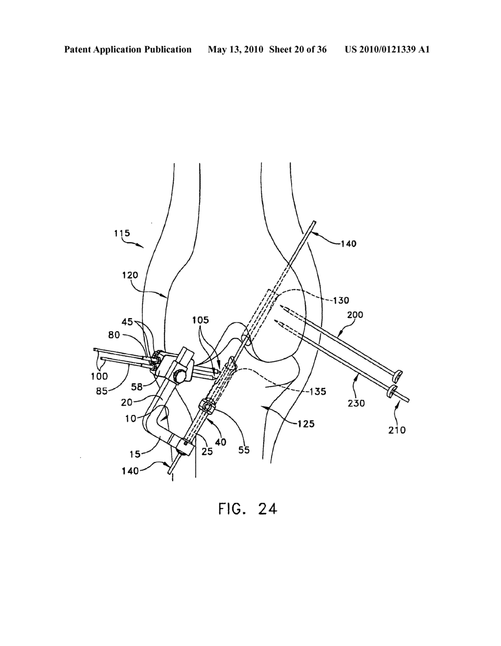 METHOD AND APPARATUS FOR FIXING A GRAFT IN A BONE TUNNEL - diagram, schematic, and image 21