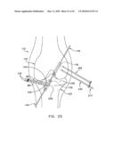 METHOD AND APPARATUS FOR FIXING A GRAFT IN A BONE TUNNEL diagram and image