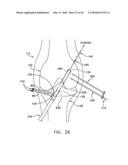 METHOD AND APPARATUS FOR FIXING A GRAFT IN A BONE TUNNEL diagram and image