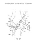 METHOD AND APPARATUS FOR FIXING A GRAFT IN A BONE TUNNEL diagram and image