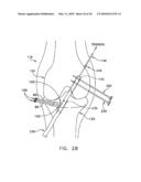 METHOD AND APPARATUS FOR FIXING A GRAFT IN A BONE TUNNEL diagram and image