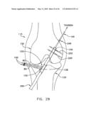 METHOD AND APPARATUS FOR FIXING A GRAFT IN A BONE TUNNEL diagram and image