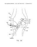 METHOD AND APPARATUS FOR FIXING A GRAFT IN A BONE TUNNEL diagram and image