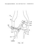 METHOD AND APPARATUS FOR FIXING A GRAFT IN A BONE TUNNEL diagram and image