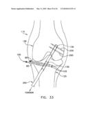 METHOD AND APPARATUS FOR FIXING A GRAFT IN A BONE TUNNEL diagram and image