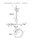 DEVICE FOR THE INTRAOSTEAL SEIZING OF SUTURES diagram and image