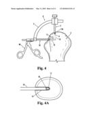 DEVICE FOR THE INTRAOSTEAL SEIZING OF SUTURES diagram and image