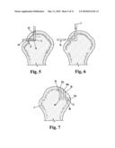 DEVICE FOR THE INTRAOSTEAL SEIZING OF SUTURES diagram and image