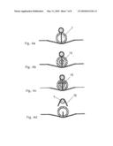 Apparatus for Minimum Invasive Fasciectomy diagram and image