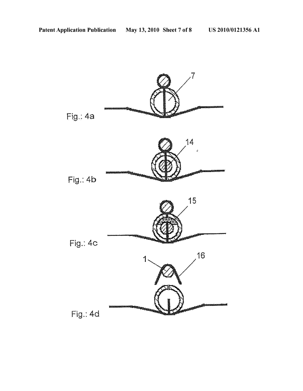 Apparatus for Minimum Invasive Fasciectomy - diagram, schematic, and image 08