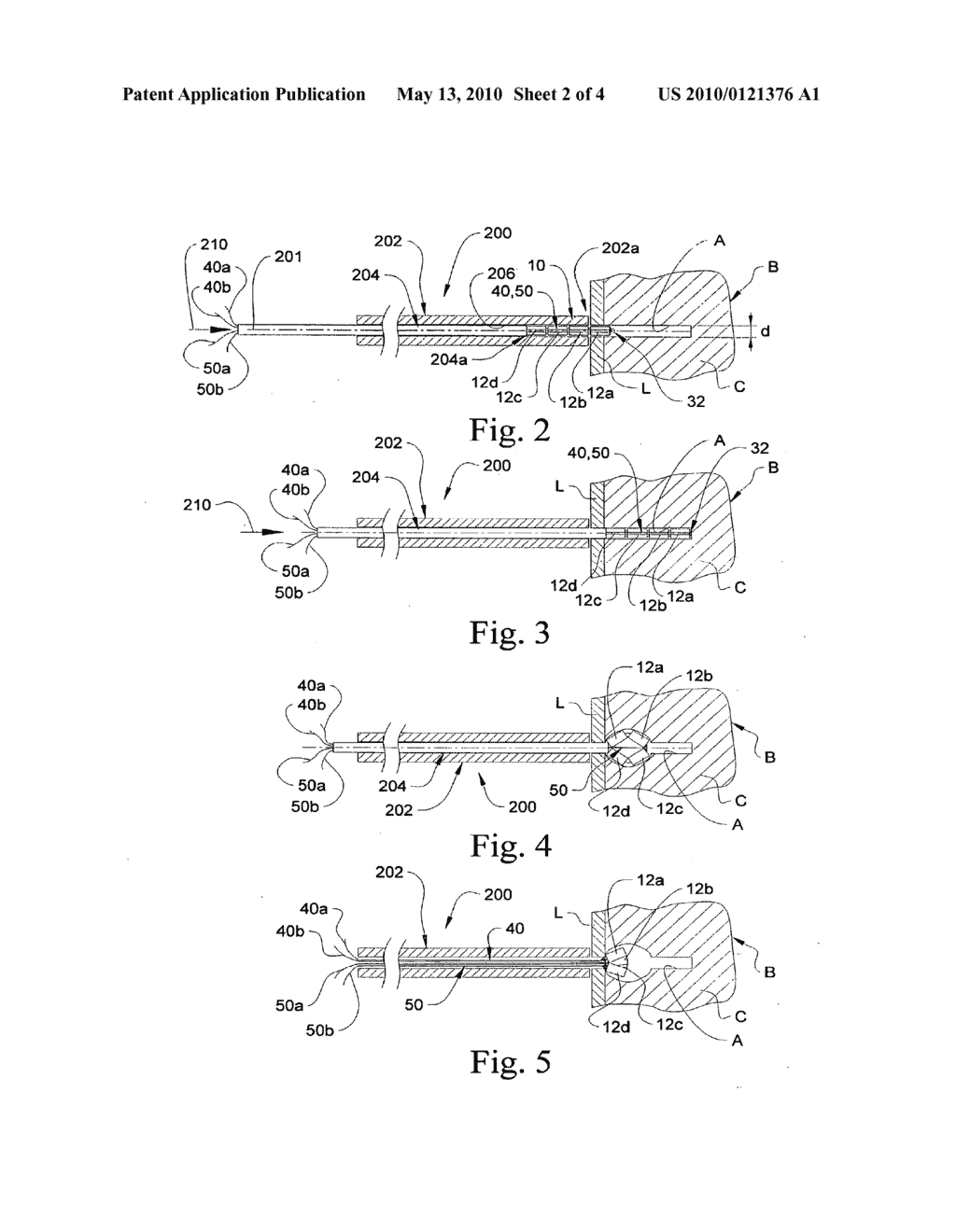 Suture Anchoring System and Method - diagram, schematic, and image 03