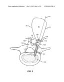 Progressive Reduction Instrument for Reduction of a Vertebral Rod and Method of Use diagram and image