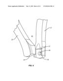 Progressive Reduction Instrument for Reduction of a Vertebral Rod and Method of Use diagram and image