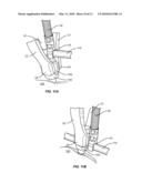 Progressive Reduction Instrument for Reduction of a Vertebral Rod and Method of Use diagram and image