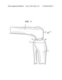 Method of preparing a femur for implantation of a femoral implant diagram and image