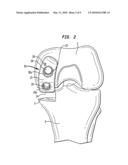 Method of preparing a femur for implantation of a femoral implant diagram and image